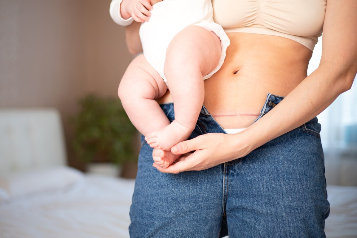 femme ayant subit une césarienne avec son bébé